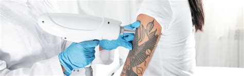science  tattoo removal