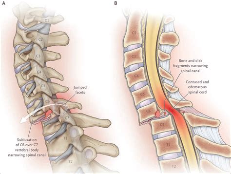 spinal cord compression nejm resident