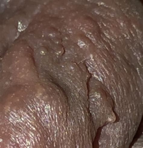 genital warts pics included sexual health forums patient