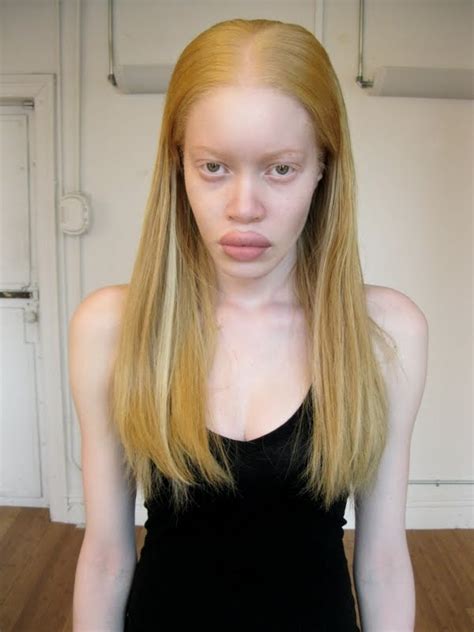 Albino Black People With Blonde Hair