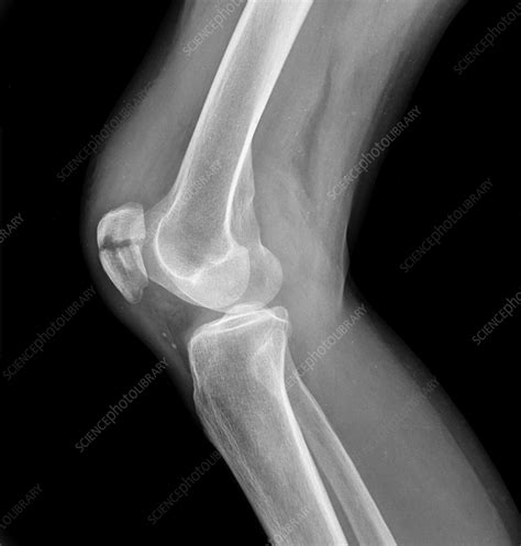 Broken Knee Cap X Ray Stock Image F036 0218 Science Photo Library