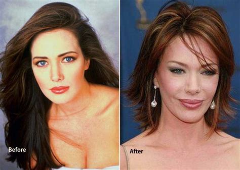 Hunter Tylo Plastic Surgery Everything Gone Wrong