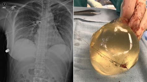 Womans Breast Implant Deflects Bullet Saving Her Life Cnn