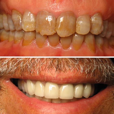 smile transformation    dental crowns