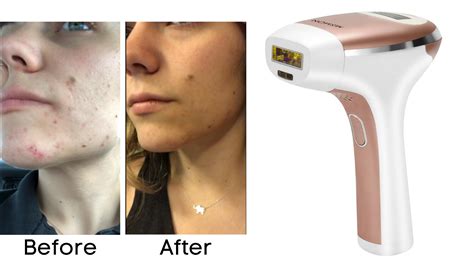 home hair removal laser buy maharsh ipl laser hair removal