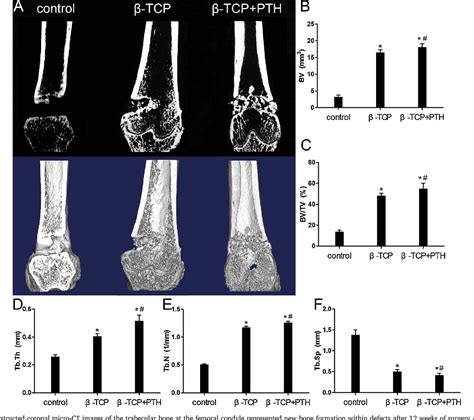 teriparatide promotes healing  critical size femur defect  accelerating angiogenesis