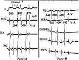 Adenosine Tachycardia Electrophysiologic Supraventricular sketch template