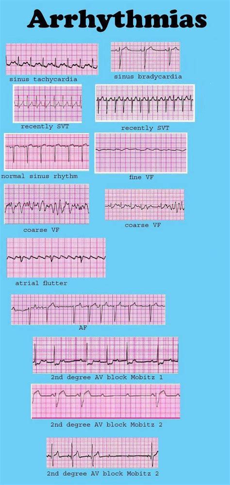 printable ekg cheat sheet customize  print