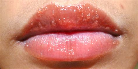 lip rash allergy pictures photos