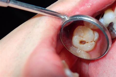 tooth decay stages complications  treatment