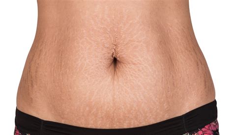 Liposuction With Stretch Marks Before And After Cosmetic Surgery Tips