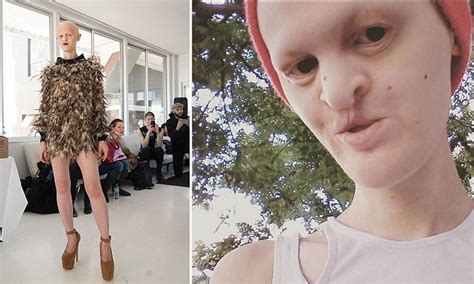 melanie gaydos model with ectodermal dysplasia storms fashion industry daily mail online