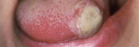 what is the cause of these aphthous ulcers if the patient also presents