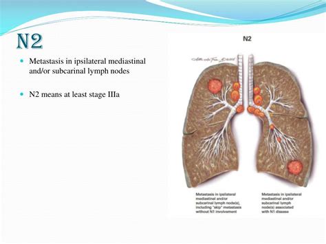 Ppt Lung Cancer Staging Powerpoint Presentation Free Download Id