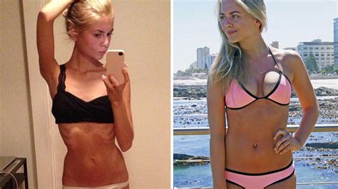 I Didn T Want To Be The Anorexic Girl Woman Reveals How She Won
