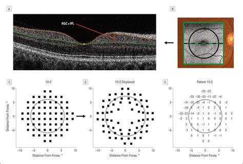retinal ganglion cell layer thickness  local visual field