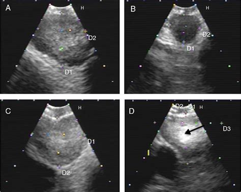 Figure 1 From Real Time Prediction Of Mediastinal Lymph Node Malignancy