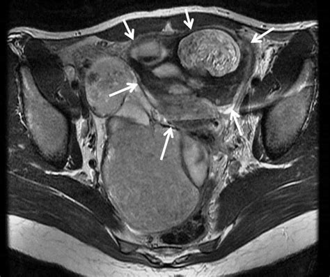 cureus  missed diagnosis  ovarian torsion   patient  bilateral ovarian dermoid cysts