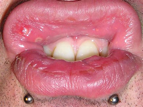 mouth ulcers causes symptoms treatment and prevention