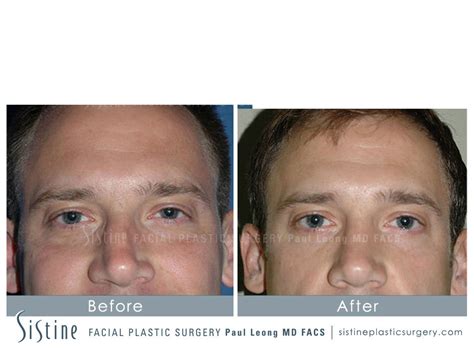 Nose Before And After 33 Sistine Facial Plastic Surgery