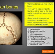 Bildergebnis für Multiple Schaltknochen in Den Schädelnähten Wormian bones. Größe: 189 x 185. Quelle: www.slideserve.com