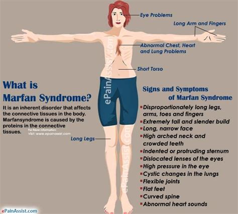 What Is Marfan Syndrome Marfan Syndrome Syndrome