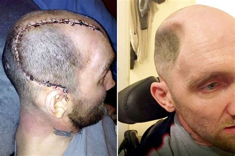 horrific pictures show man who had skull caved in after a
