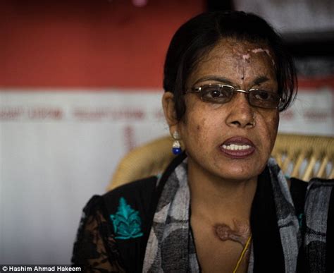 The Courageous Indian Women Scarred For Life From Acid Attacks Daily
