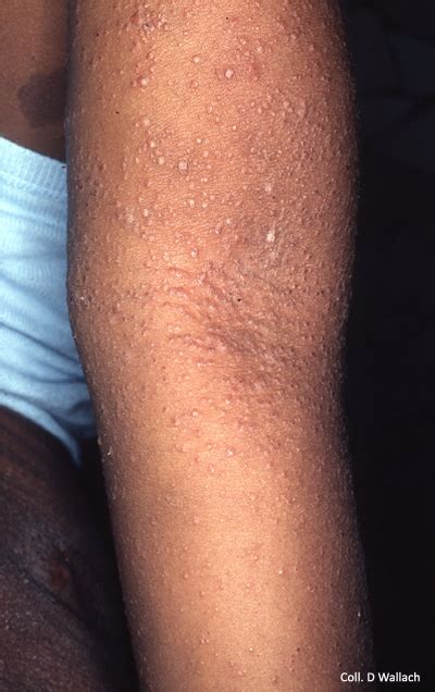 Atopic Dermatitis And Dark Skin Foundation For Atopic