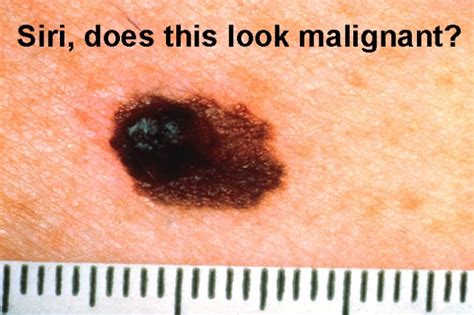 Melanoma Misdiagnosis Yep There’s An App For That Ars