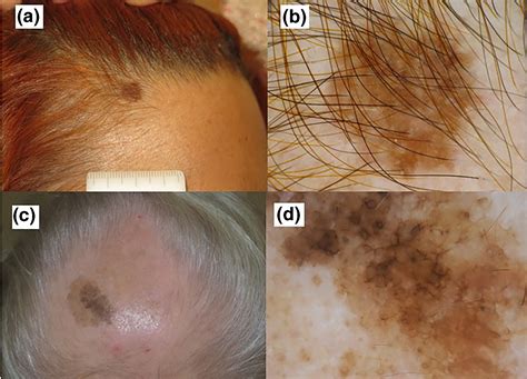 melanoma  scalp pictures early stage  scalp melanoma images melanoma  neck pictures