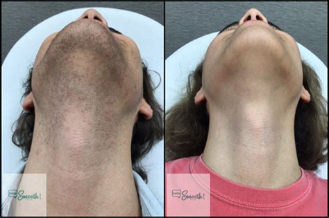 top  image facial laser hair removal thptnganamsteduvn