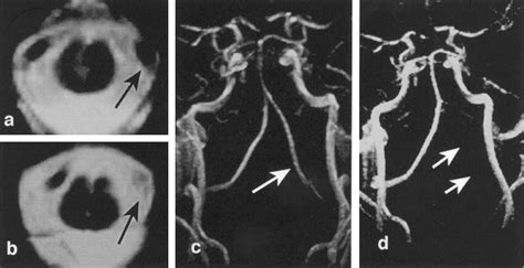 Unruptured Intracranial Vertebral Artery Dissection Stroke