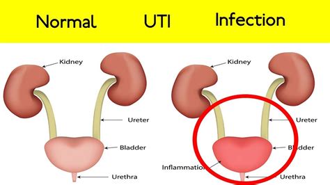 top  home remedies  urinary tract infections youtube