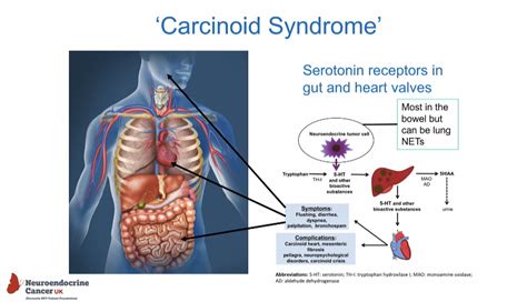 Carcinoid Syndrome Pathophysiology Signs And Symptoms Symptoms