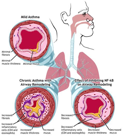 children  asthma hubpages