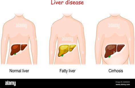 Liver Diseases Stages Of Liver Damage Healthy Fatty And Cirrhosis