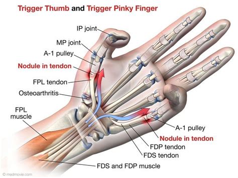 trigger finger fort worth tx  hand  shoulder center