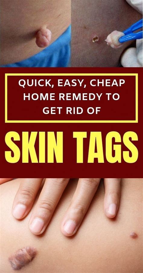how to remove skin tags naturally natural home remedies for skin tags