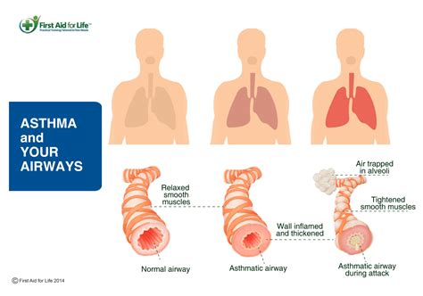 asthma stay safe  older people