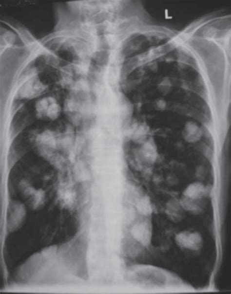 lung cancer 3 buyxraysonline