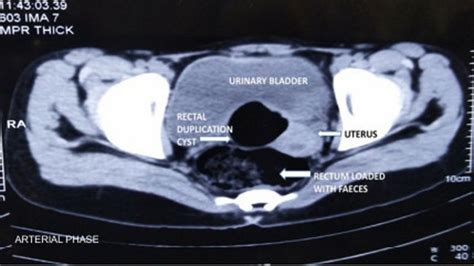 rectal duplication cyst causing acute urinary retention with bladder