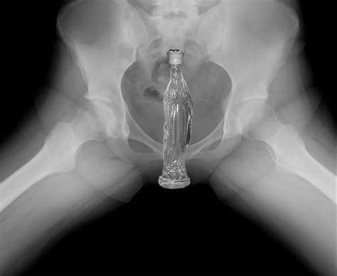 how anal sex x ray