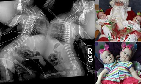 Conjoined Twins X Ray Shows The Complicated Procedure Facing Doctors