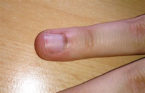 verfaerbungen  einem fingernagel  ist dad medizin fingernaegel