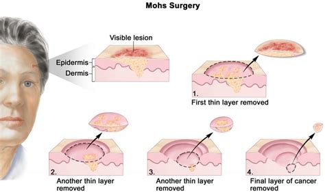 mohs case   infiltrative basal cell carcinoma