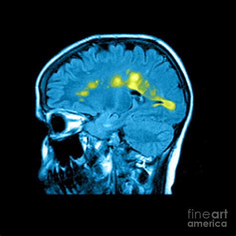 Mri Of Multiple Sclerosis Photograph By Medical Body Scans Fine Art
