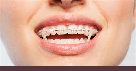 long  wear rubber bands  braces chatham orthodontics