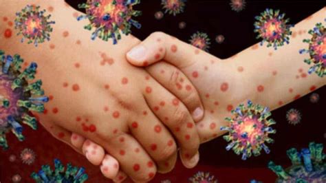 Chickenpox Symptoms Causes Treatment And Prevention