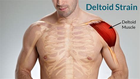 deltoid strain treatment  symptoms classification